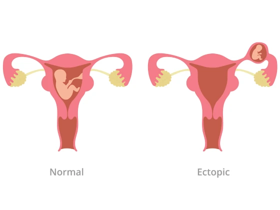 ectopic