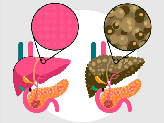 fatty liver