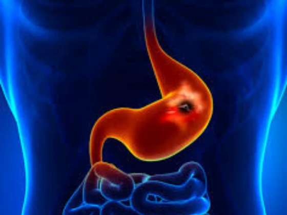 gastric duodenal ulcer