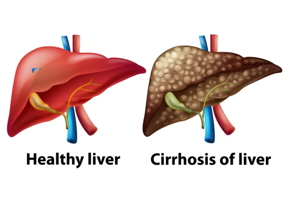 liver cirrhosis