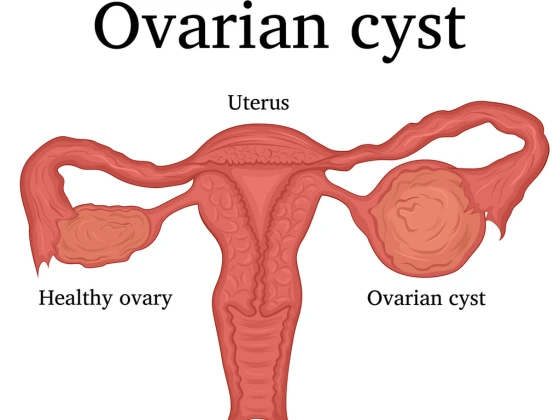 ovarian