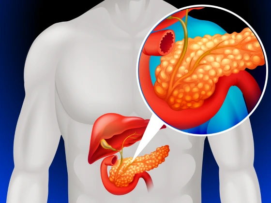 pancreatitis